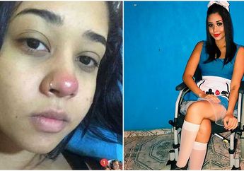 Lakukan Tindik Hidung, Gadis 20 Tahun Ini Terkena Infeksi yang Sebabkan Dirinya Lumpuh Seumur Hidup