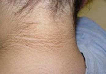 Jangan Dianggap Sepele, Kulit Leher Hitam dan Menebal Ternyata Bisa Menandakan Penyakit Berbahaya ini!