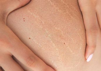 Nggak Perlu Mahal Buat Hilangkan Stretch Mark, Gunakan Bahan-bahan Ini untuk Dapatkan Kulit Mulus