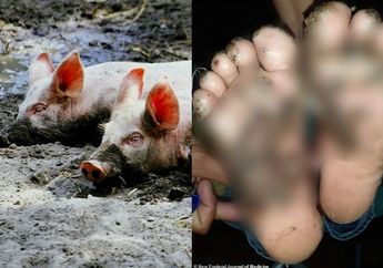 Ngeri! Kaki Bocah 10 Tahun Membusuk dan Bernanah Usai Bermain dan Lakukan Kegiatan Ini Tanpa Alas Kaki