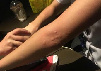 3 Obat Biduran Alami untuk Meredakan Gatal-gatal, Salah Satunya Lidah Buaya