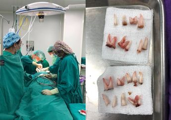 Kasihan, Seorang Anak Kehilangan 18 Gigi yang Harus Dicabut dan Hanya Tersisa 2 Gigi Karena Kebiasaan Tertidur dengan Dot di Mulut