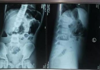 Dikira Tumor di Perut, Bocah 8 Tahun Ini Lahirkan Seorang Bayi