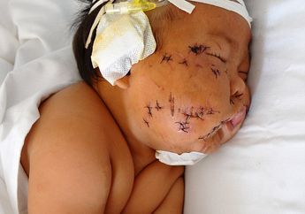 Duh Teganya, Bayi 8 Bulan Ini Ditusuk dengan Gunting 90 Kali Hanya Gara-gara Gigit Puting Ibunya Saat Menyusu