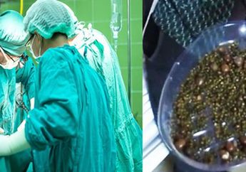 Ngeri! Akibat Jarang Sarapan, Dokter Keluarkan 2.000 Batu Empedu dari dalam Perut wanita ini