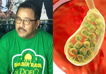 Belajar dari Rano Karno yang Tak Lagi Memiliki Empedu, Jarang Sarapan Bisa Menjadi Penyebab Penyakit Berbahaya ini