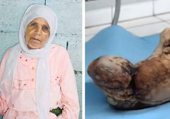 Mengerikan, Wanita ini Melahirkan 'Bayi Mumi' Setelah Memendam Kehamilan Selama 46 Tahun