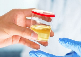 Jangan Keliru! Cari Tahu 11 Warna Urine dan Artinya Bagi Kondisi Kesehatan