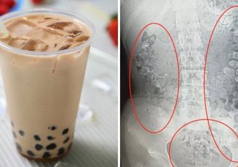 Waspada Buat Tukang Jajan! Awalnya Hanya Sakit Perut, Ternyata dalam Perut dan Usus Gadis Ini Ada 100 Lebih 'Bubble Tea'!