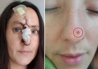 Temukan Jerawat Kecil Karena Hobi Berjemur, Wanita ini Justru Terkena Kanker Kulit