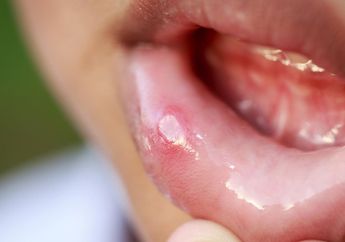 Waspadai Bercak Putih atau Kemerahan di Bibir, Bisa Jadi Tanda Kanker Mulut!