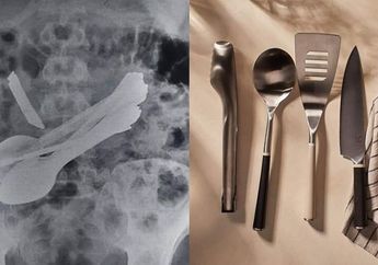 Alami Sakit Perut Luar Biasa, Dokter Terkejut Temukan Pisau, Sendok dan Obeng dalam Perut Pasiennya
