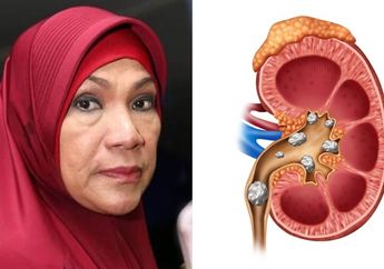 Dorce Gamalam Hidup dengan Penyakit Batu Ginjal: Ternyata Obat Batu Ginjal Ada di Rumah, Salah Satunya Air Cuka