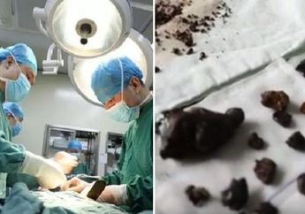 Jarang Sarapan Selama 10 Tahun, Wanita ini Keluarkan Ratusan Batu Empedu dari Perutnya!