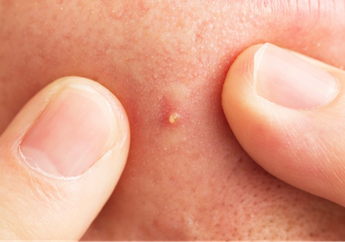Jerawat Makin Parah, 5 Kandungan Skincare Ini Harus Dihindari Saat Jerawatan!