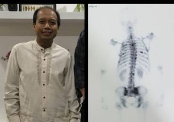 Sutopo Purwo Meninggal Usai Lawan Kanker Paru-paru, Benarkah Asap Rokok Jadi Penyebab Utama?