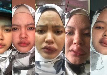 Bibir Digigit Serangga Saat Naik Motor, Atasi Dengan Bumbu Dapur