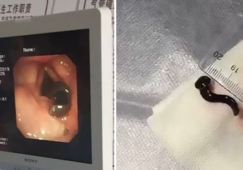 Rasakan Gatal hingga Batuk, Dokter Malah Temukan Lintah Hidup di Tenggorokan Wanita Ini! Penyebabnya Karena Air Minum