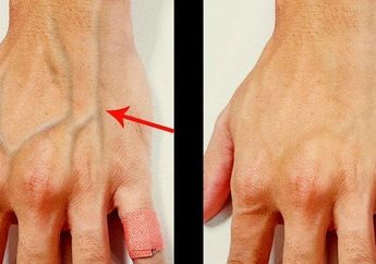 Ketahui 5 Fakta Pembuluh Darah yang Muncul di Permukaan Kulit, Berbahaya Jika Disertai Bisul dan Sesak Nafas