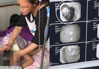 Perut Gadis 9 Tahun Ini Dipenuhi Gumpalan Aneh, Keluarga Kaget Saat Tahu Sang Anak Mengonsumsi Benda Tak Lazim Ini