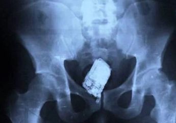 Lihat 6 Foto Rontgen Tubuh yang Tak Lazim, Dari Cincin Lamaran Hingga Granat Tangan