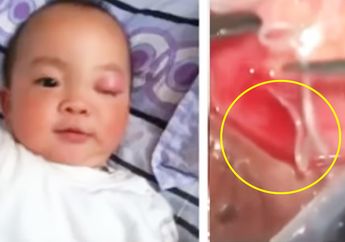 Menakutkan, Ada 10 Cacing di Mata Seorang Balita, Ternyata Salah Satunya Tak Lakukan Ini Sebelum Makan