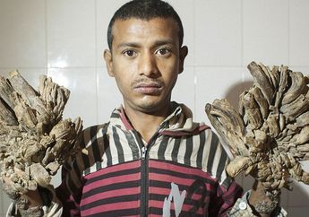 Terkena Penyakit Langka Hingga Disebut 'Manusia Pohon', Pria ini Memilih Amputasi Tangannya
