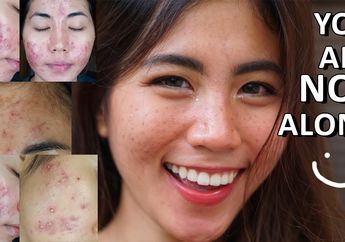 Kisah Puspita Mayangsari, Beauty Influencer yang Hidup dengan Wajah Penuh Jerawat namun Sembuh dari Pola Makan Ini