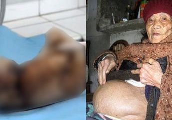 Wanita ini Hamil Selama 46 Tahun, Saat Melahirkan Kondisi Bayinya Mengenaskan