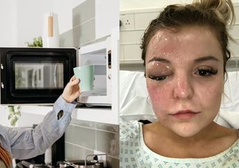 Waspada! Wanita Ini Nyaris Buta Karena Microwave Makanan Ini dan Meledak Tepat di Wajahnya!