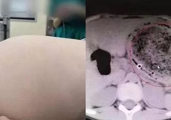 Rutin Makan Rambutnya Sendiri Sejak Usia 2 Tahun, Dokter Temukan Hal Mengerikan ini di Dalam Perutnya