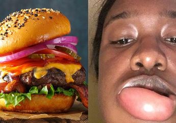 Dikira Hanya Bengkak Biasa Karena Makan Burger, Bibir Remaja ini Terus Membesar dan Rupanya Idap Penyakit Berbahaya