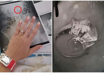 Bangun Tidur Wanita Ini Kaget Cincinnya Hilang, Saat di Periksa Dokter Benda Itu Sudah Ada di Perutnya