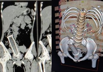2 Tahun Menahan Sakit di Perutnya, Dokter Keluarkan Stang Motor dari Dalam Rahim Wanita ini