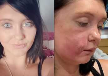 Lakukan Filler pada Wajah Sendiri, Penampilan Wanita 26 Tahun Ini Bukannya Jadi Cantik tapi Malah Mengerikan!