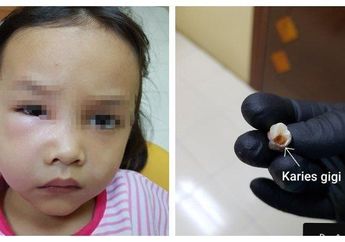 Bahaya! Jarang Sikat Gigi Setelah Makan Makanan Manis, Wajah Gadis Kecil Ini Bengkak dan Alami Hal Mengerikan