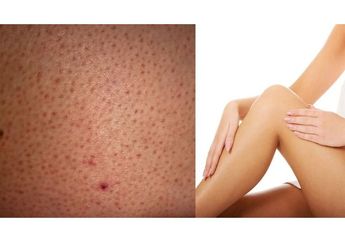 Hilangkan Bintik Merah Usai Cukur Bulu Kaki, #5MenitAja dengan Bahan Alami Ini