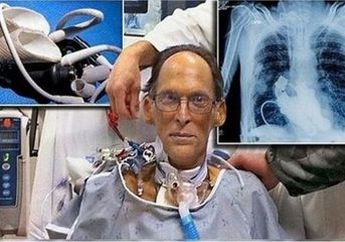Dokter Sebuth Hidupnya Tinggal 12 Jam, Pria Ini Nekat untuk Ambil Keputusan Hidup Tanpa Jantung, Ini Alat Penyelamat Hidupnya