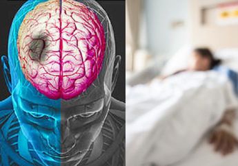 Makanan Penyebab Stroke, 3 Makanan Enak Ini Diam-diam Bisa Sebabkan Stoke! Kita Makan Hampir Tiap Hari