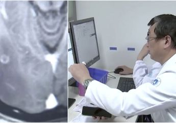 Muntah-muntah Setelah Makan Daging Mentah, Dokter Terkejut dengan Isi Kepala Seorang Pasien, 'Setiap Ahli Medis Harus Waspada'