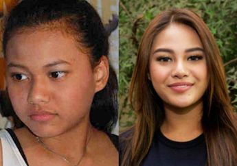 Bertahun-tahun Tampik Isu Operasi Plastik, Aurel Akhirnya Akui Lakukan Operasi Agar Wajahnya Lebih Tirus! Rahasia Dapur Terbongkar