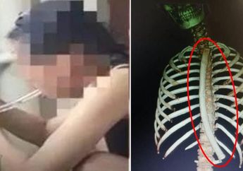 Panjangnya 30 Cm, Selang Ini Tak Sengaja Tertelan oleh Seorang Wanita, Ternyata Begini Kisah di Baliknya hingga Bikin Borok