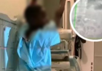 Usianya Baru 7 Tahun, Bocah Ini Dilarikan ke Rumah Sakit Setelah Menelan Apple AirPods, Ibunya: 'Dia Anak yang Gila'