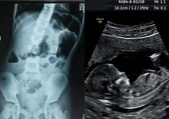 Anak 8 Tahun yang Dikira Memiliki Tumor di Perutnya Ternyata Hamil, Dokter Ungkap Fakta Memilukan Janin dalam Kandungannya