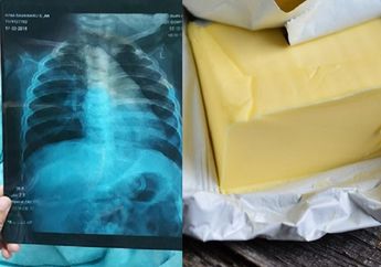 Makanan Penyebab Pneumonia, Selain Rokok, Jauhi Deretan Makanan Enak Ini Jika Masih Sayang Paru-paru Anda!