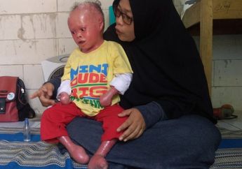 Curhatan Seorang Ibu Lahirkan Anak Penderita Penyakit Langka Kulit Kura-kura, Awalnya Syok Tapi Tak Tahan Dengar Putranya Disamakan dengan Genderuwo!