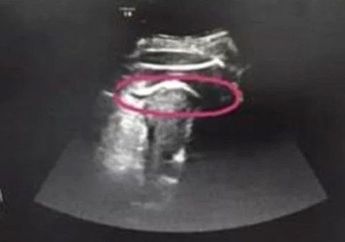 Saat USG Terlihat Kaki Janin Ini Menendang Rahim Ibunya dan Robek, Suasana di Ruang Dokter itu pun Berubah Panik, Apa yang Terjadi?