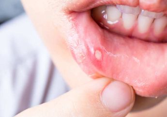 Bau Mulut Parah dan Banyak Gigi Berlubang Pertanda Jelas Diabetes