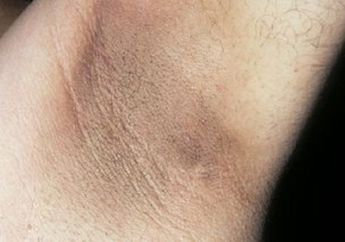 Waspada! Ketiak Hitam Ternyata Bisa Jadi Gejala Awal Tubuh Anda Terserang Penyakit Mengerikan Ini, Perhatikan Mulai Sekarang