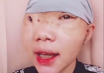 Berkat Main Tiktok, Gadis Asal Palangkaraya yang Sempat Dihujat karena Alami Kecelakaan Rambut Terllilit Mesin Perahu hingga Kulit Kepalanya Rusak Parah Kini Kembali Tampil Percaya Diri